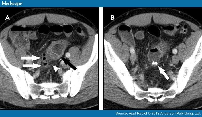 MDCT of the Small Bowel