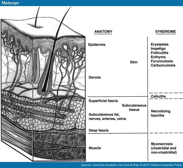 Necrotizing Fasciitis