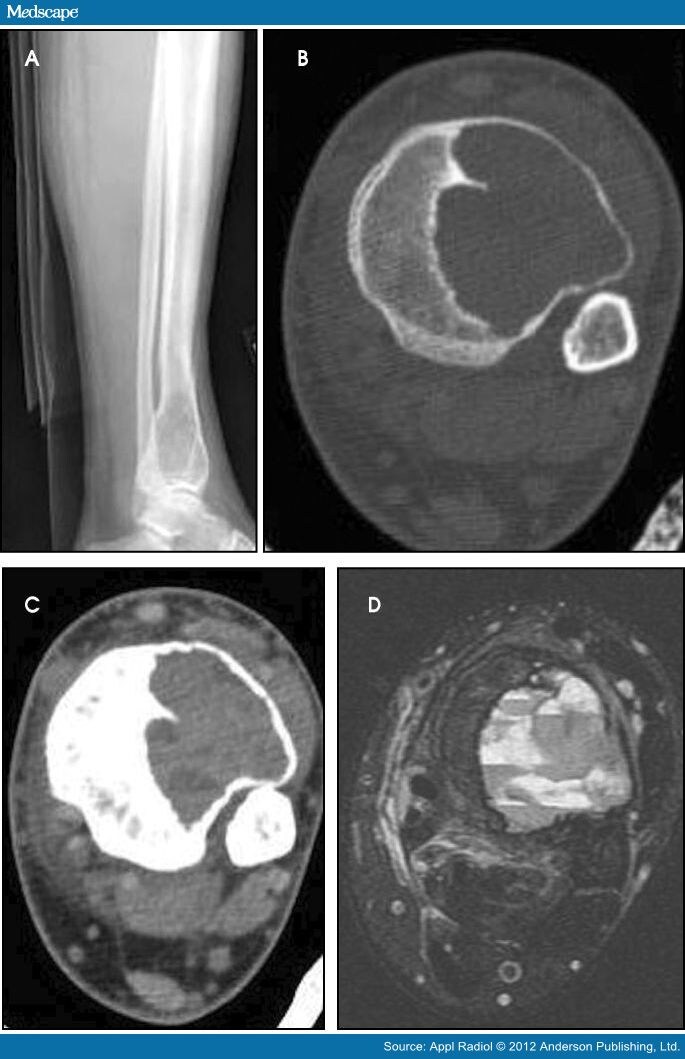 Bone Tumors and Tumor-like Conditions of Bone