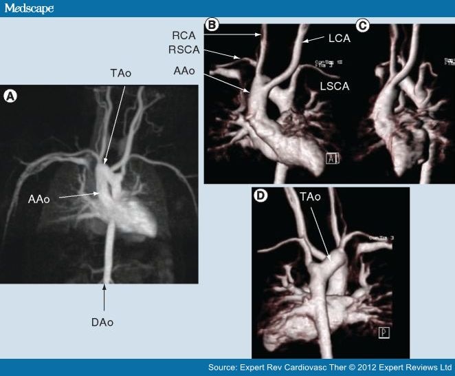 Imaging of Aortic Arch Anomalies and Associated Findings