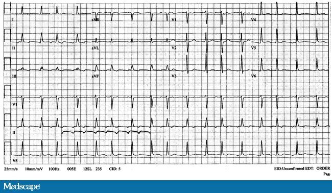 Atrial flutter with variable AV conduction ratio - 非官方教學網