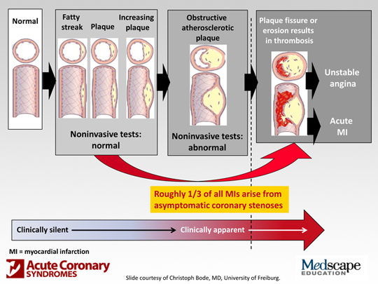 Investigating Coronary Artery Disease: Imaging and Characterizing ...