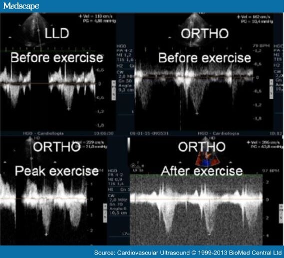 Clinical Applications of Exercise Stress Echocardiography