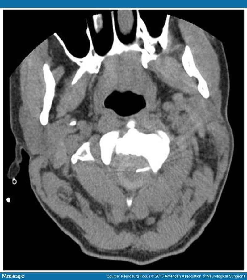 Cordotomy for Treatment of Cancer-Related Pain