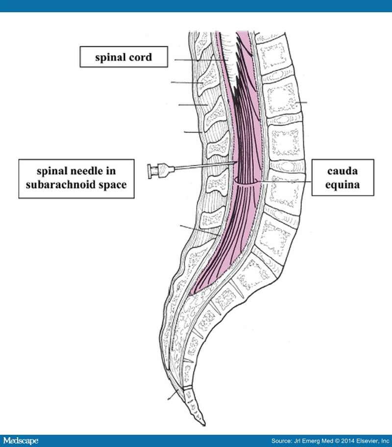 Lumbar Puncture Landmarks