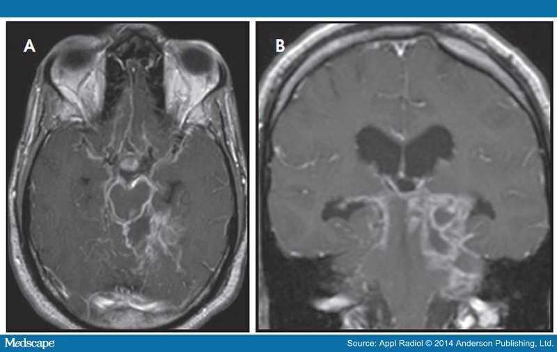 Imaging of Intracranial Infectious Diseases in Adults