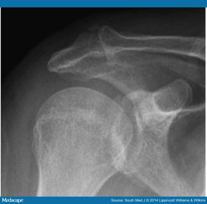 Acromioclavicular Osteoarthritis: A Cause of Shoulder Pain