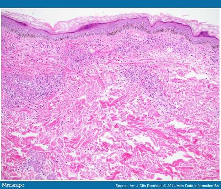 A Practical Approach to Cutaneous Small-Vessel Vasculitis