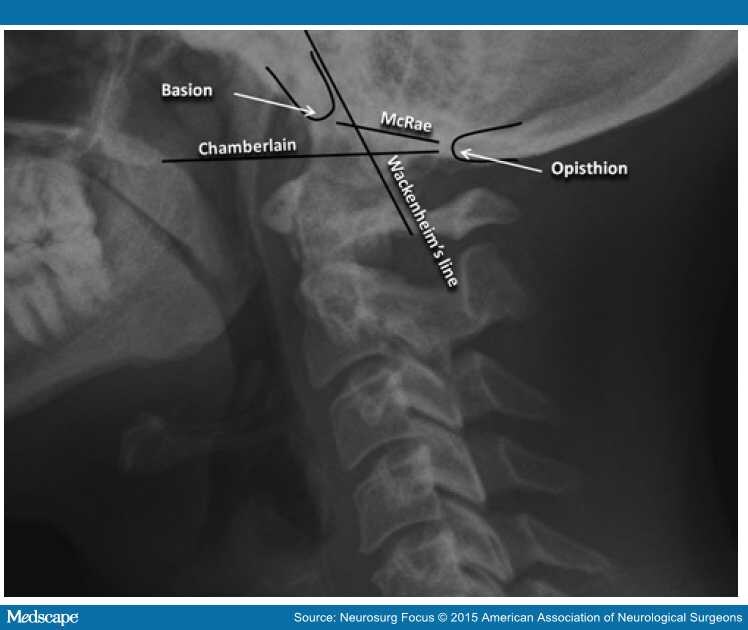 Radiological Evaluation of Cervical Spine Involvement in RA