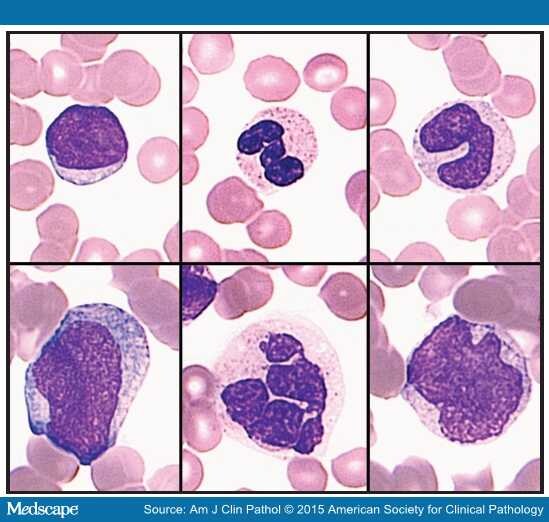 AML With Recurrent Cytogenetic Abnormalities