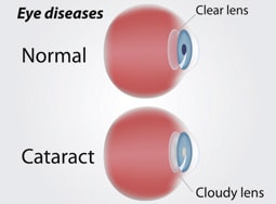 Cataracts