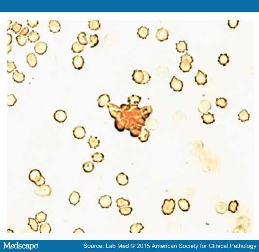 Rh Immunoprophylaxis for Women With a Weak D Phenotype