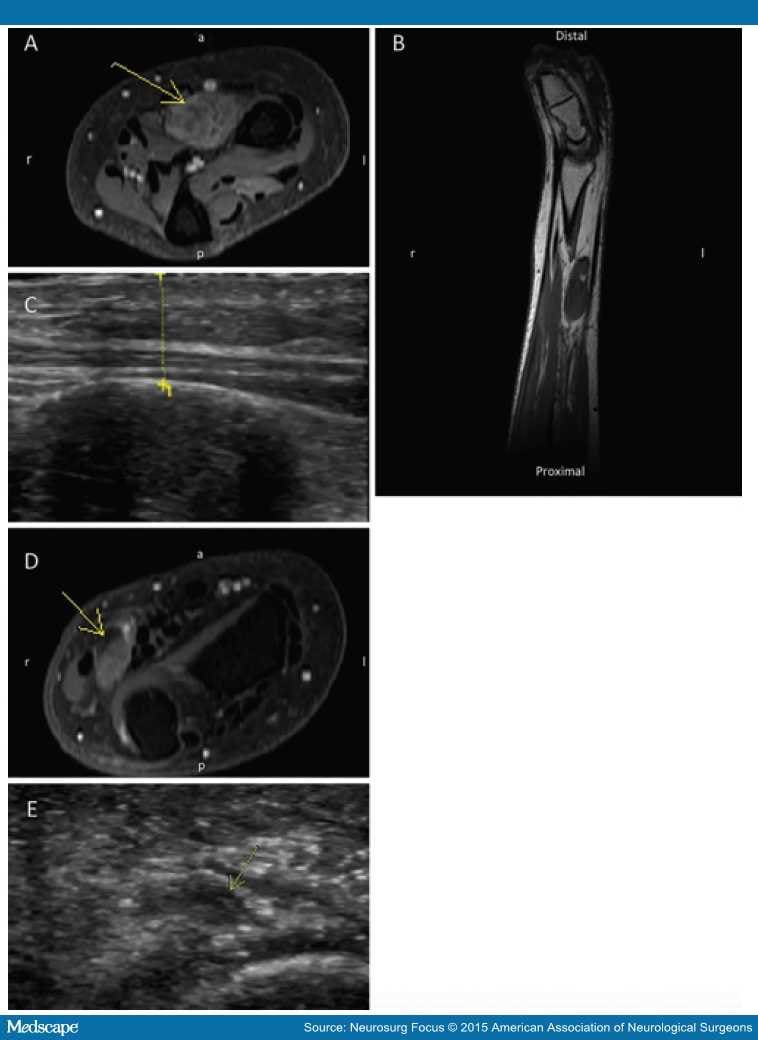 Intraoperative Ultrasound-assisted Peripheral Nerve Surgery