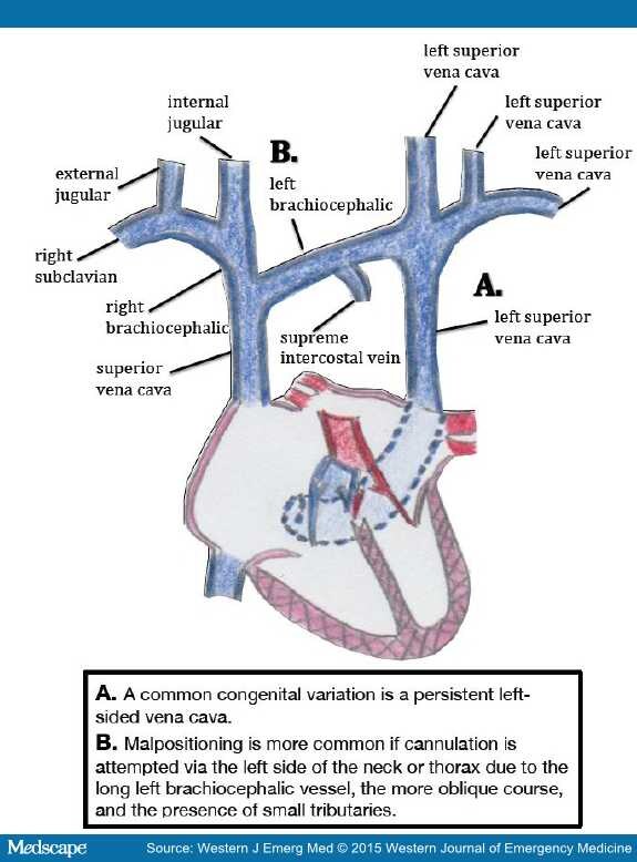 Central Venous Catheter Intravascular Malpositioning