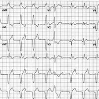 ECG Challenge: Uncontrolled Hypertension