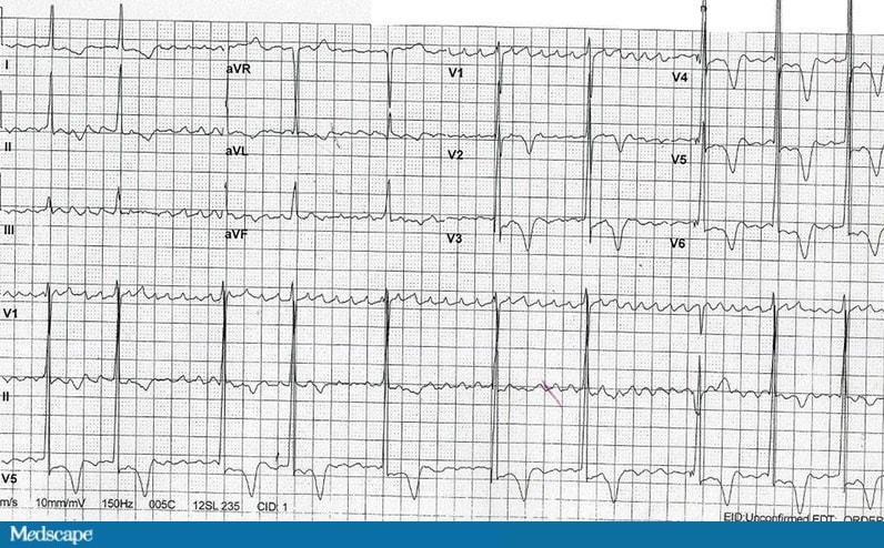 ECG Challenge: What Is This Irregularly Irregular Rhythm?