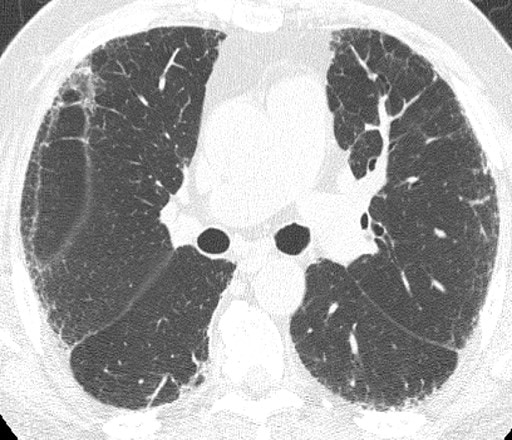 Idiopathic Pulmonary Fibrosis in Images: Interpreting HRCT and ...