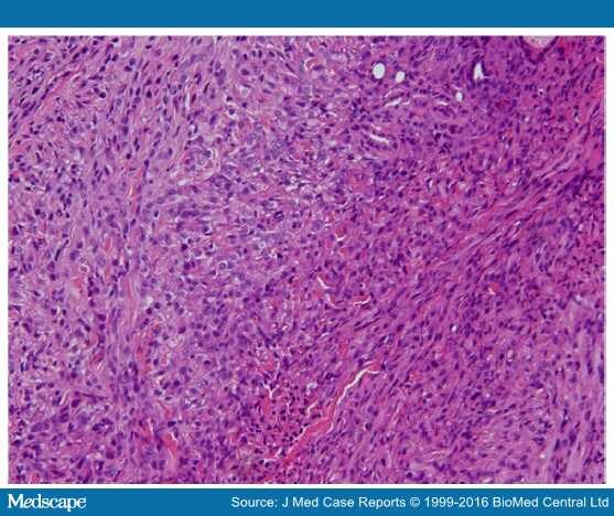 Epithelioid Sarcoma With Multiple Lesions on the Left Arm