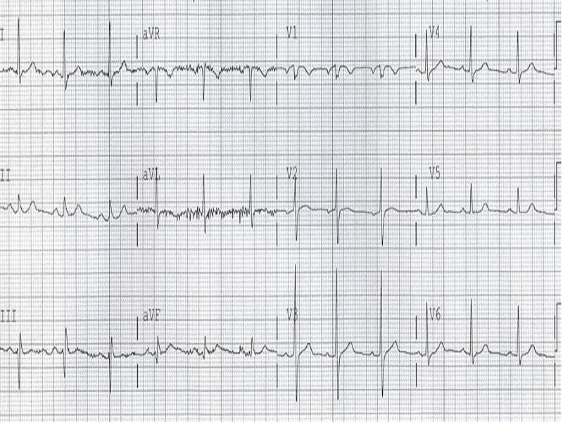 A Man With Worsening Chest Pain After a Respiratory Infection