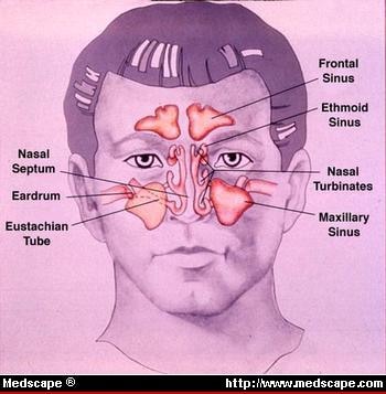 Sinusitis: Diagnosis and Treatment