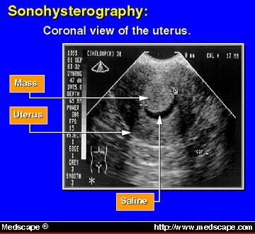 Contemporary Concepts in Managing Menorrhagia