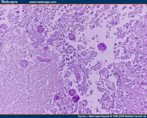 Entamoeba Liver Abscess