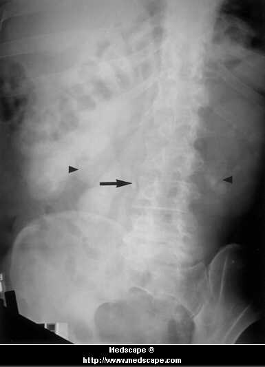 A Tortuous Ureter and Urolithiasis