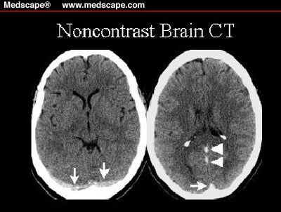 A 28-Year-Old Woman With Severe Headaches