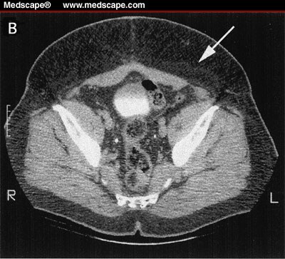 Abdominal Carcinomas Mimicking HIV-Associated Lipodystrophy