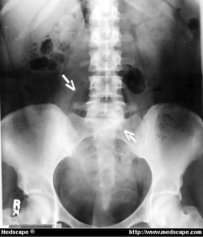 Ovarian Teratoma With a High Level of Differentiation