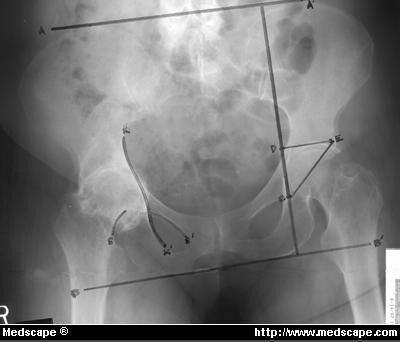 A 78-Year-Old Woman with Right Hip Pain