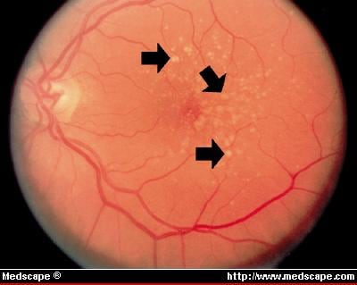 Neovascular Age-related Macular Degeneration