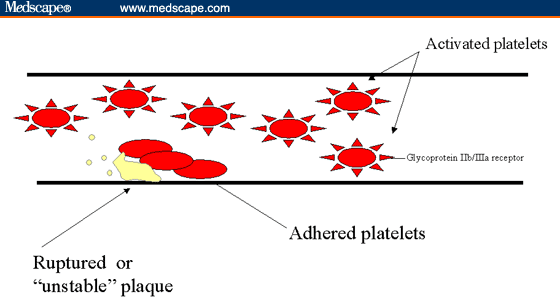 Administration of Glycoprotein IIb-IIIA Inhibitors