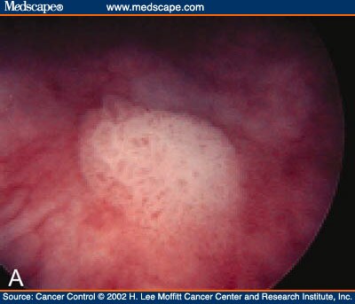 Surgical Management of Bladder Carcinoma