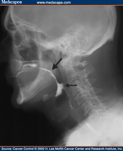 Oropharyngeal Dysphagia in Head and Neck Cancer