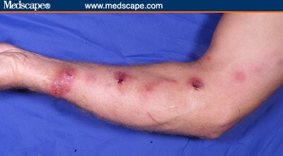 Ulcerating Nodules on the Arm