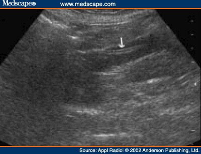 Biliary Ascariasis