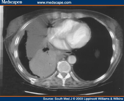 Pleural Effusion Caused by Trapped Lung