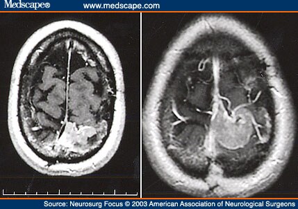 Stereotactic Radiosurgery for Intracranial Meningiomas