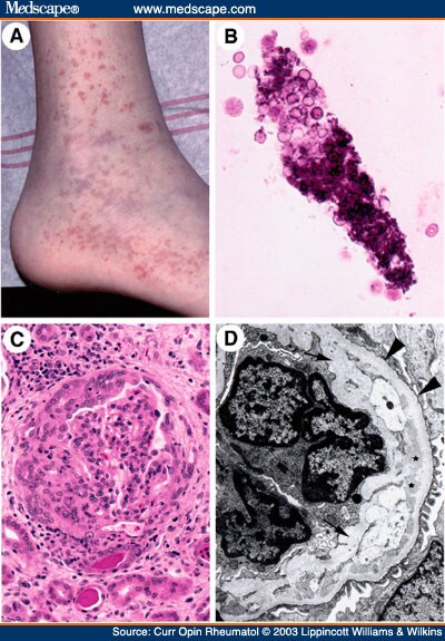 Autoimmunity in Wiskott-Aldrich Syndrome