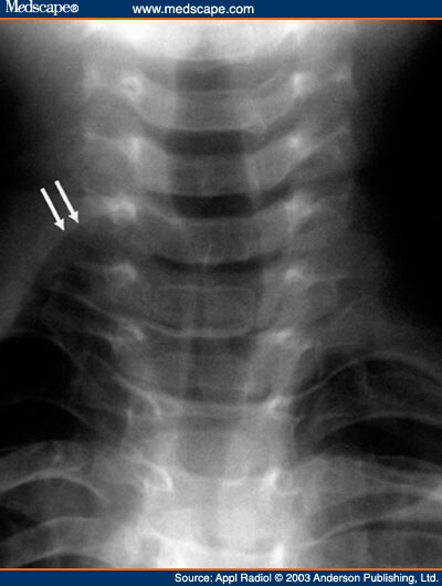 Congenital Cervical Lung Herniation