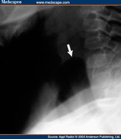 Congenital Cervical Lung Herniation