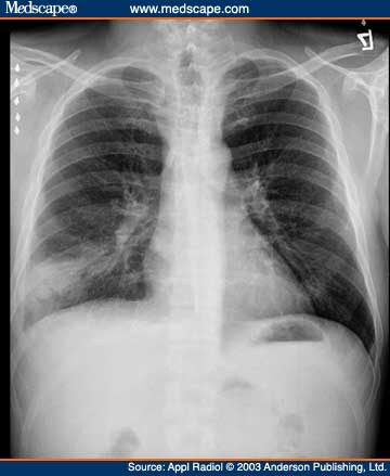 Disseminated Nocardia Asteroides Infection