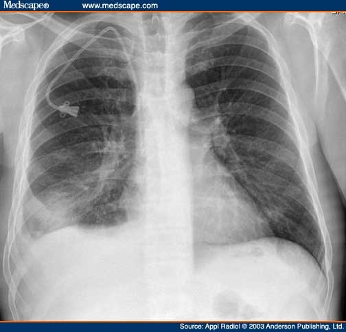 Disseminated Nocardia Asteroides Infection