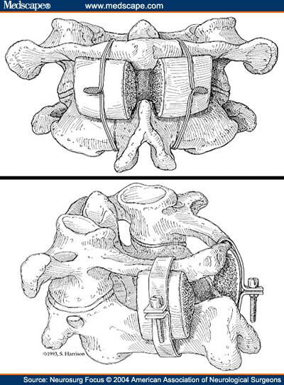 The Evolution of Posterior Cervical and Occipitocervical Fusion