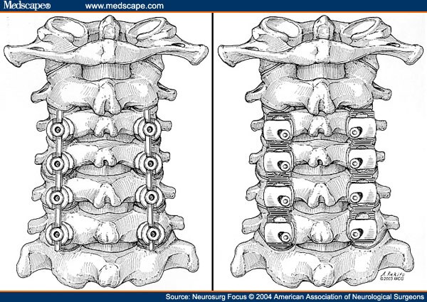 The Evolution of Posterior Cervical and Occipitocervical Fusion