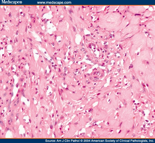 Human Herpesvirus 8 Immunostaining