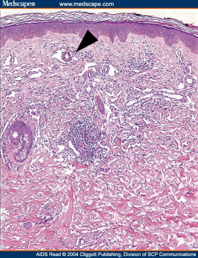 Management of AIDS-Related Kaposi Sarcoma: Advances in Target