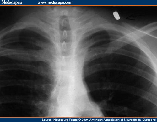 Penetrating Injuries Due to Gunshot Wounds