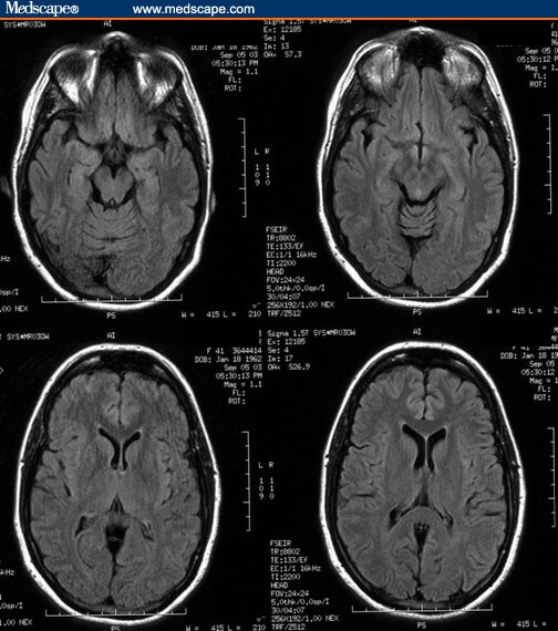 Pseudotumor Cerebri Mri